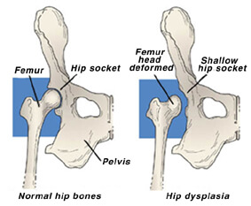 Hip Dysplasia diagrammatic illustration